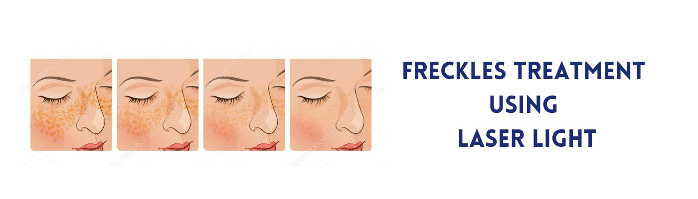 Freckles treatment using Laser Light Freckles treatment using Laser Light