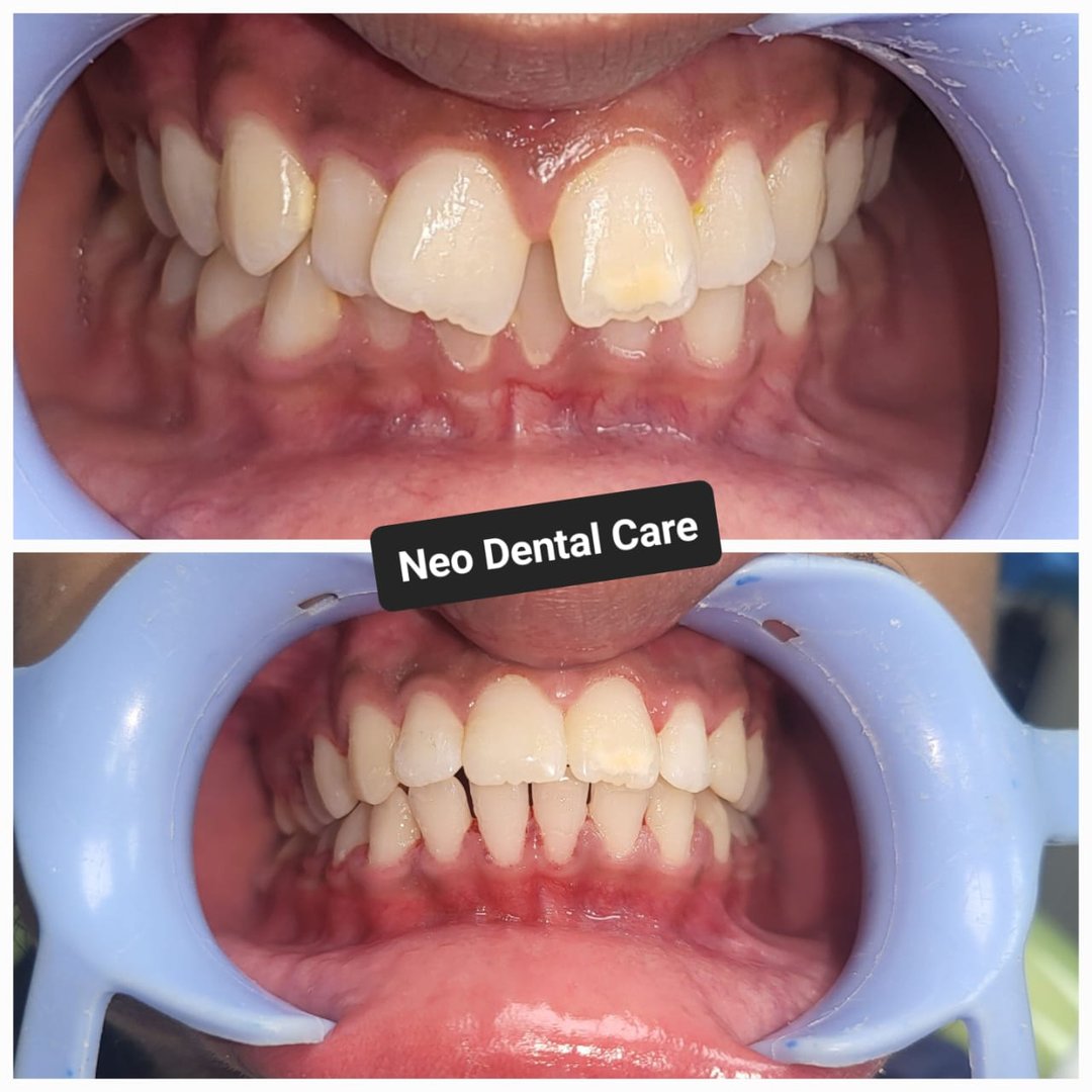 Orthodontic correction using damon braces Orthodontic correction using damon braces