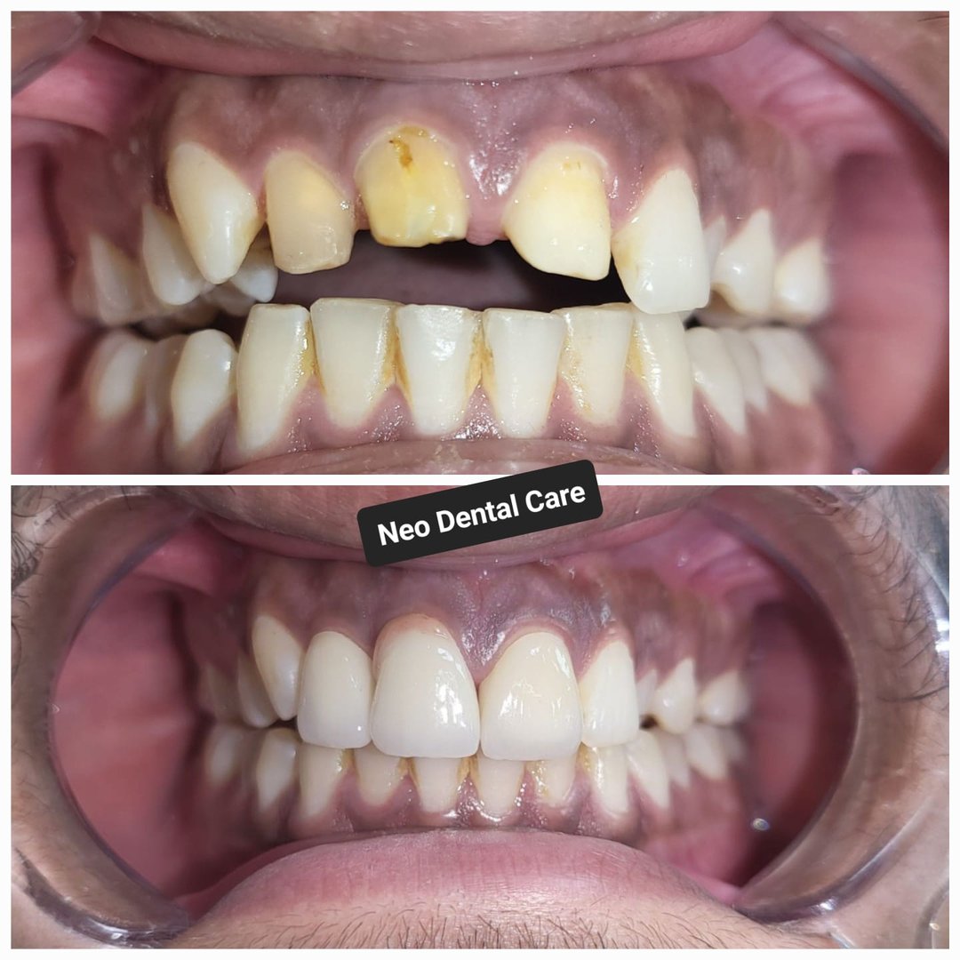 Upper front teeth rehabilitation with All ceramic crowns Upper front teeth rehabilitation with All ceramic crowns