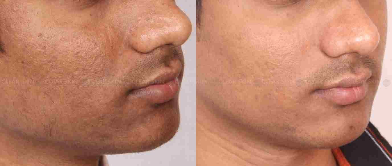 Laser Treatment for Hyperpigmentation: