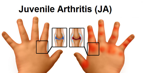 Management And Prevention of Juvenile Rheumatoid Arthritis in Ayurveda