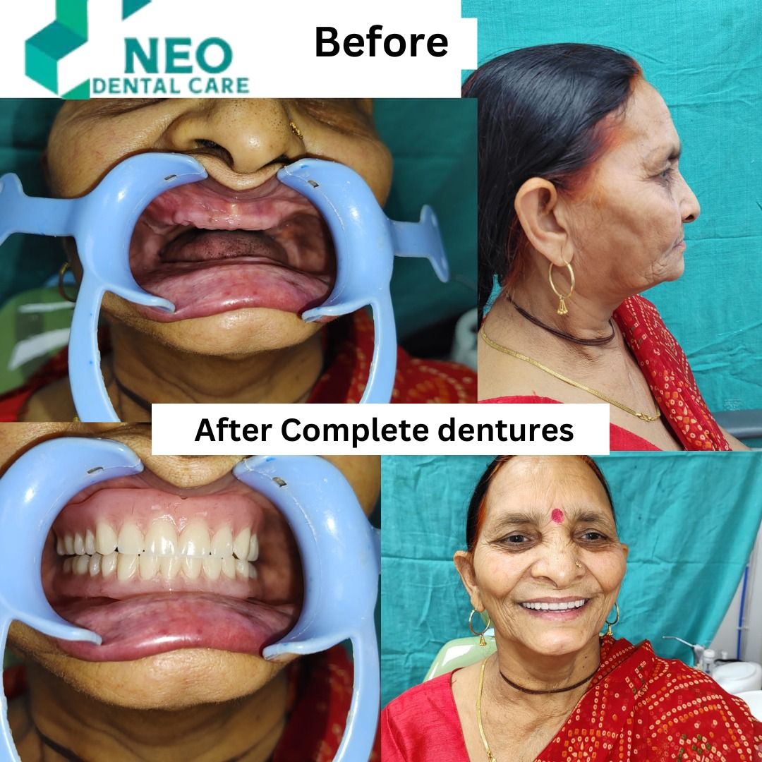 Before & After Complete Dentures