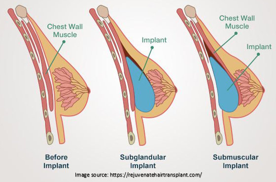 breast reconstruction surgery procedure