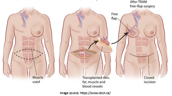 Autologous tissue reconstruction