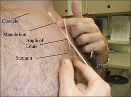 neck contracture