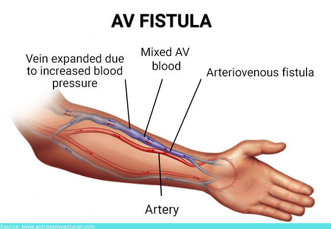 AV fistula In Dialysis