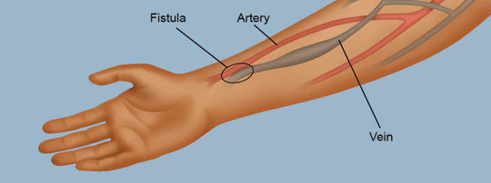 AV fistula,