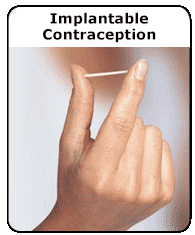 Implantable Contraception (for Teens) - Nemours KidsHealth