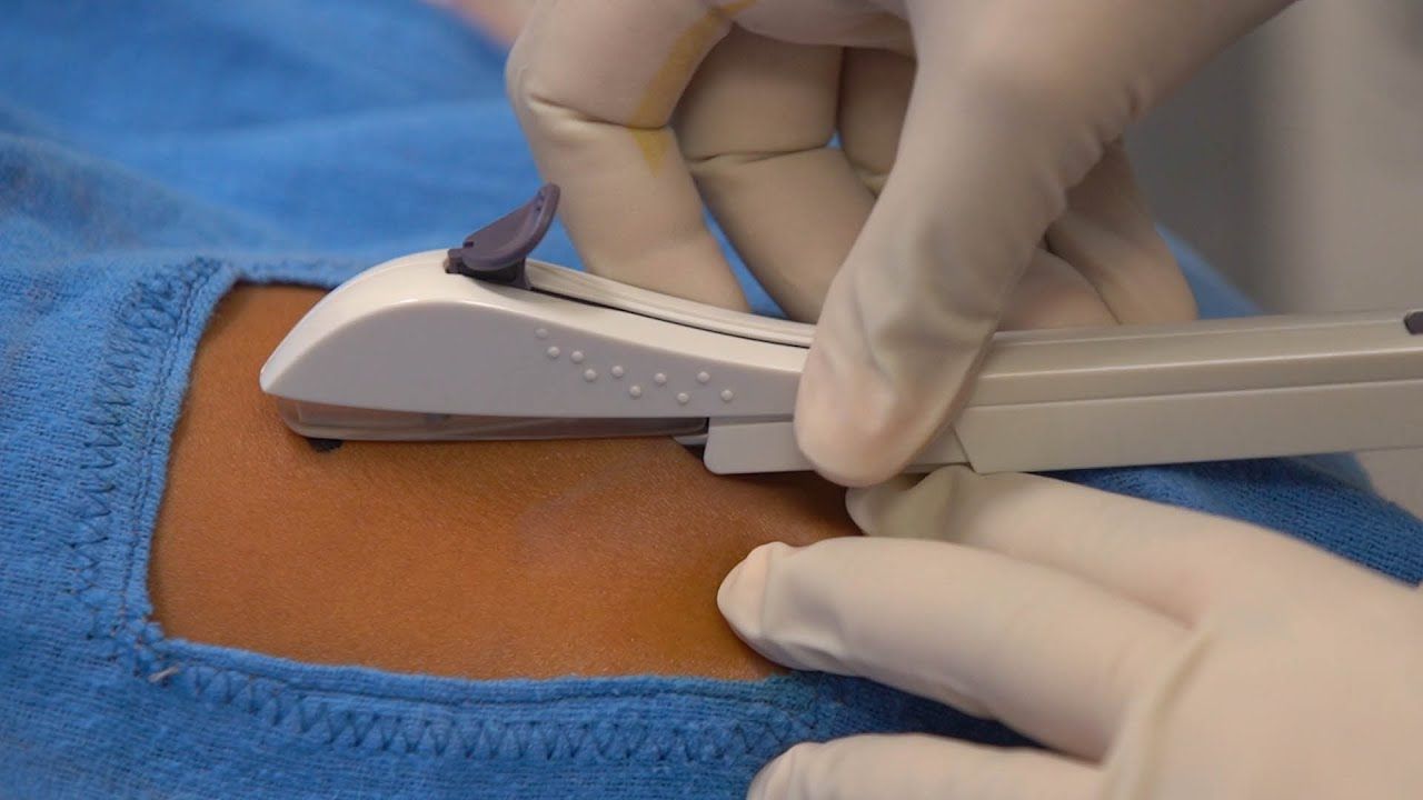 Inserting a One Rod Implant - Video - Global Health Media Project