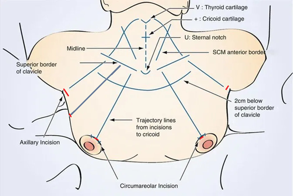 Robotic Assisted Breast-Axillo Insufflate Thyroidectomy (RABIT)