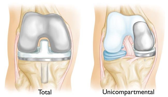 Unicompartmental (Partial) Knee Replacement - OrthoInfo - AAOS