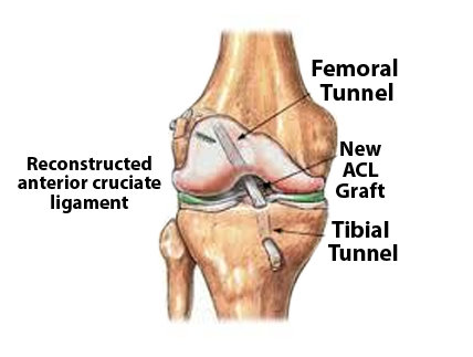 Anterior Cruciate Ligament (ACL) Reconstruction with Allograft (Includes  Implants & Hardware) – St. George Surgical Center