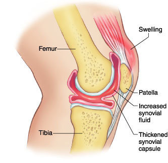 Synovectomy