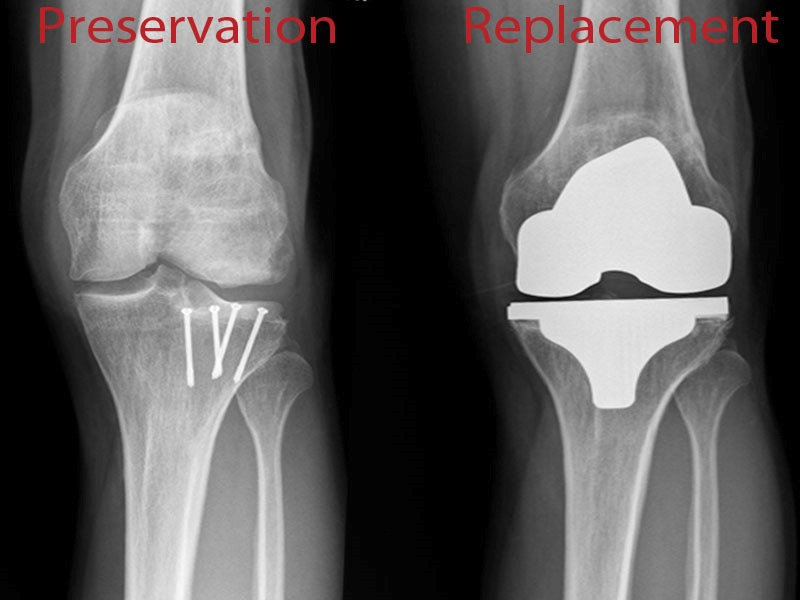 Joint Preservation vs. Replacement: What's Your Best Option? | Joint  Preservation Institute