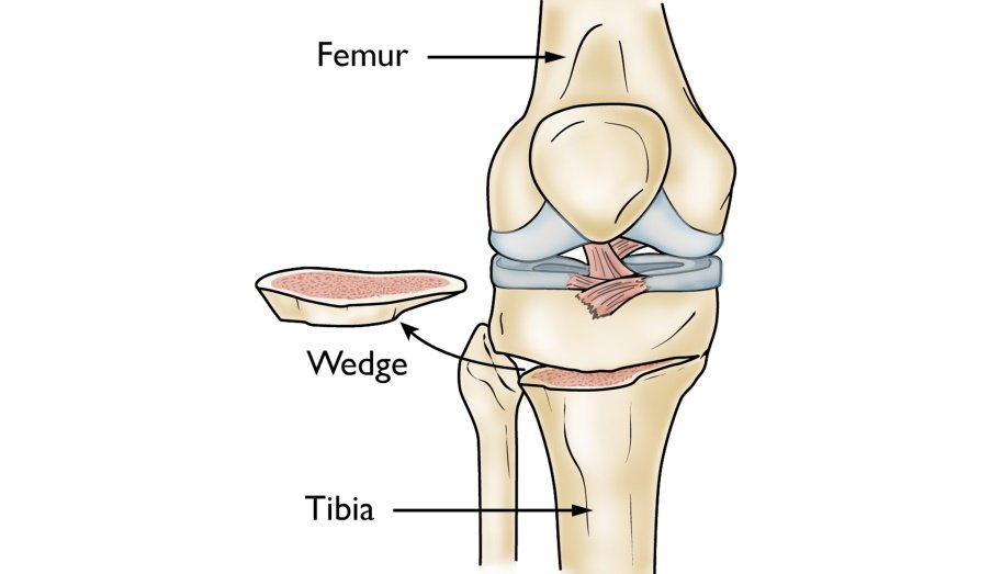 Osteotomy of the Knee - OrthoInfo - AAOS