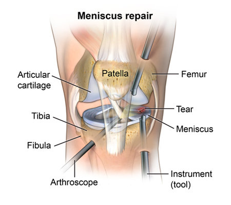 Arthroscopic Meniscal Repair – Aster Speciality Clinic