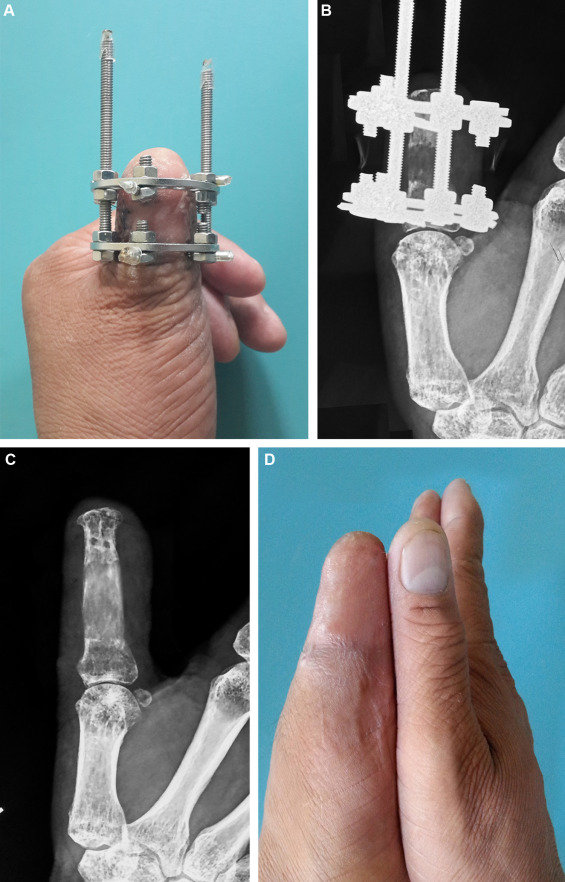 Thumb lengthening using a three-dimensional half-ring distraction frame - ScienceDirect