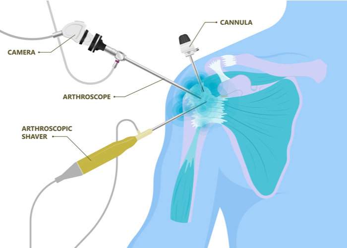 CAM Procedure | Shoulder Joint Preservation | Osteoarthritis