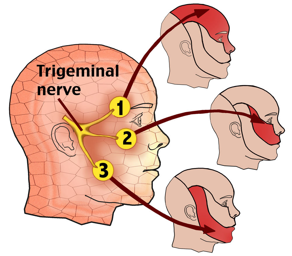 trigeminal neuralgia trigger points