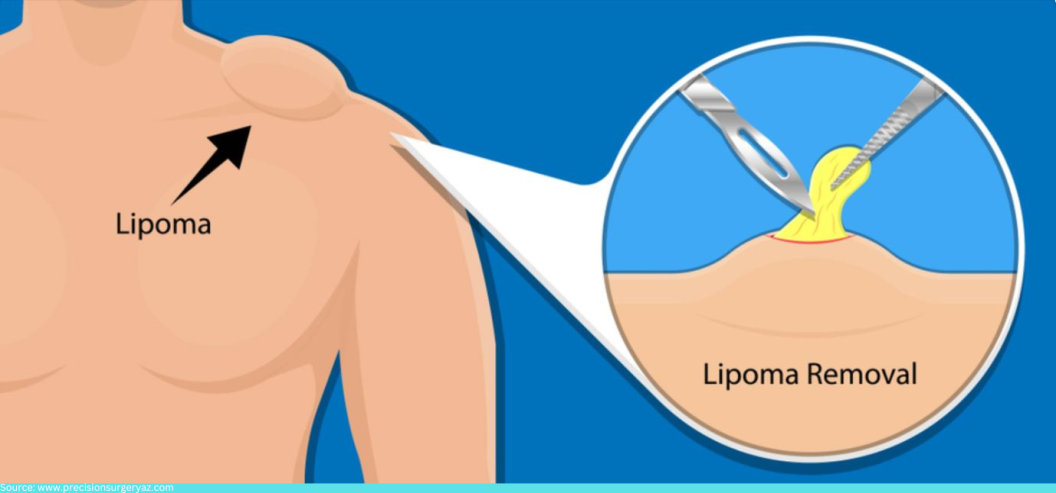 Lipoma Removal