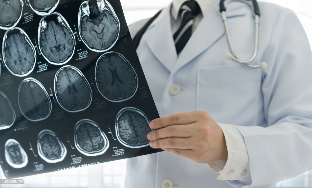 Life Expectancy After Mini-stroke Life Expectancy After Mini-stroke