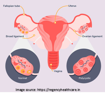 PCOS Reproductive system