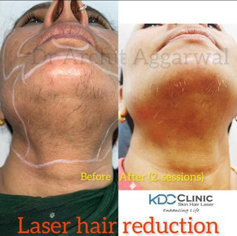 How to Calculate the Cost of Laser Hair Removal in Faridabad