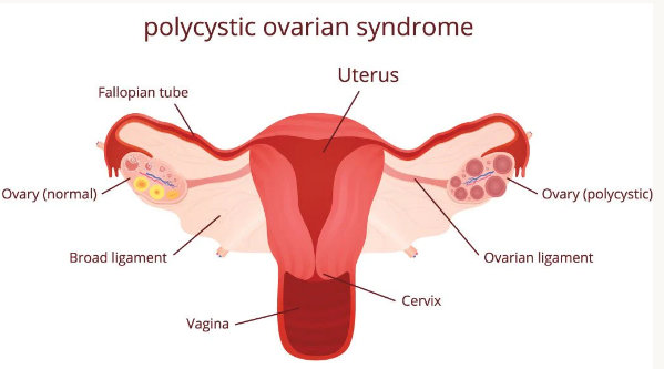 PCOS treatment in mumbai