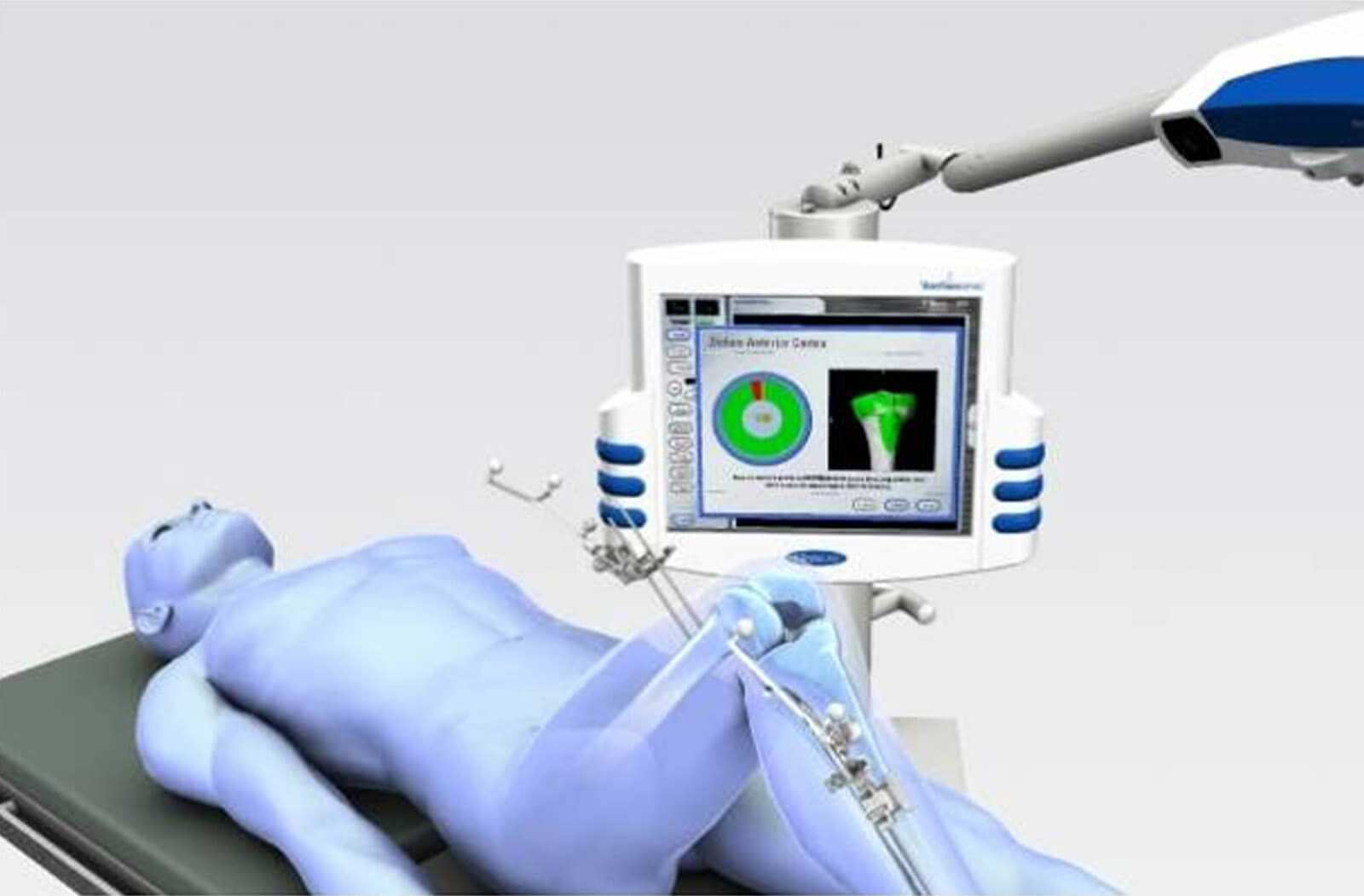 Computer Assisted Navigation (CAN) Knee Replacement - King's College Hospital London in Dubai