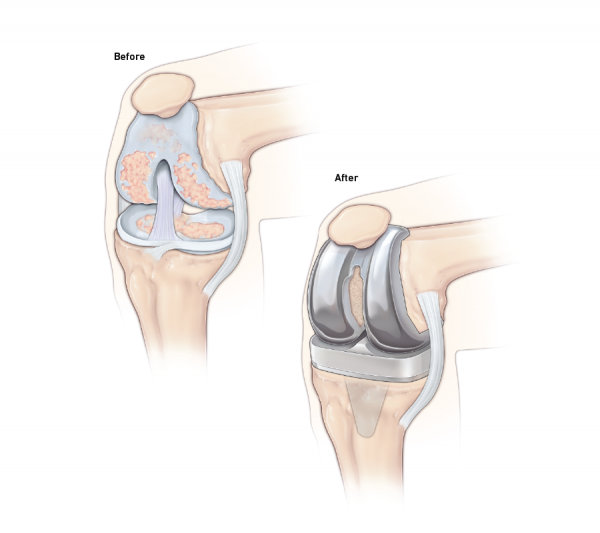 Knee Replacement Surgery | Temple Health