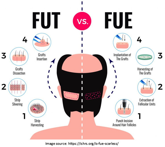 FUT Vs FUE