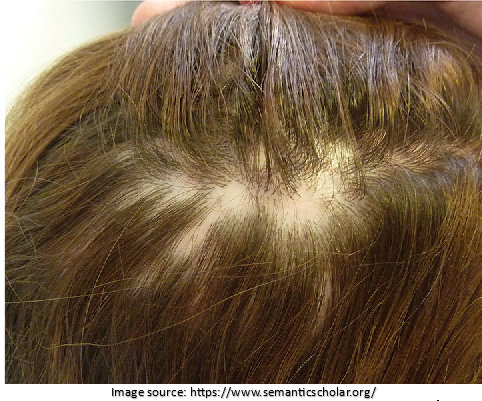 Scarring Alopecia & causes