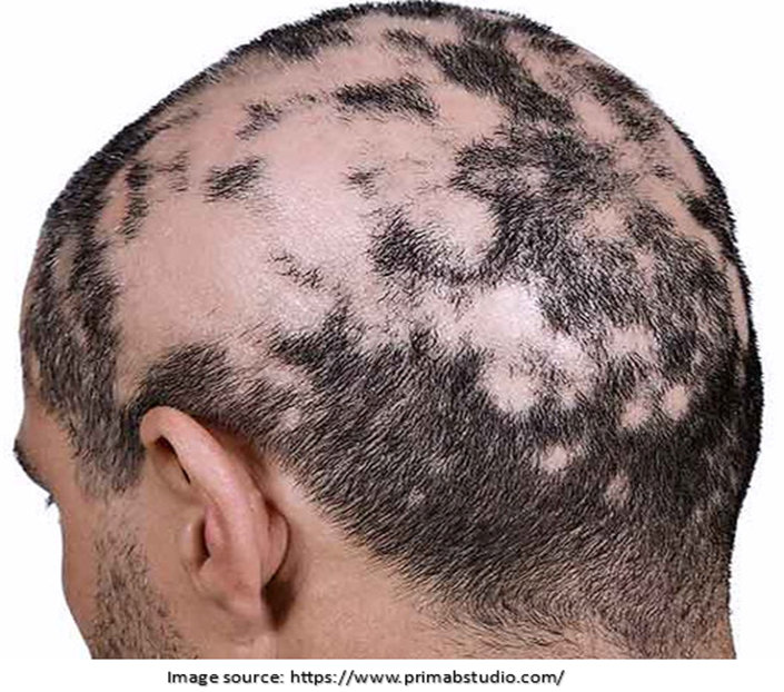 Scarring Alopecia