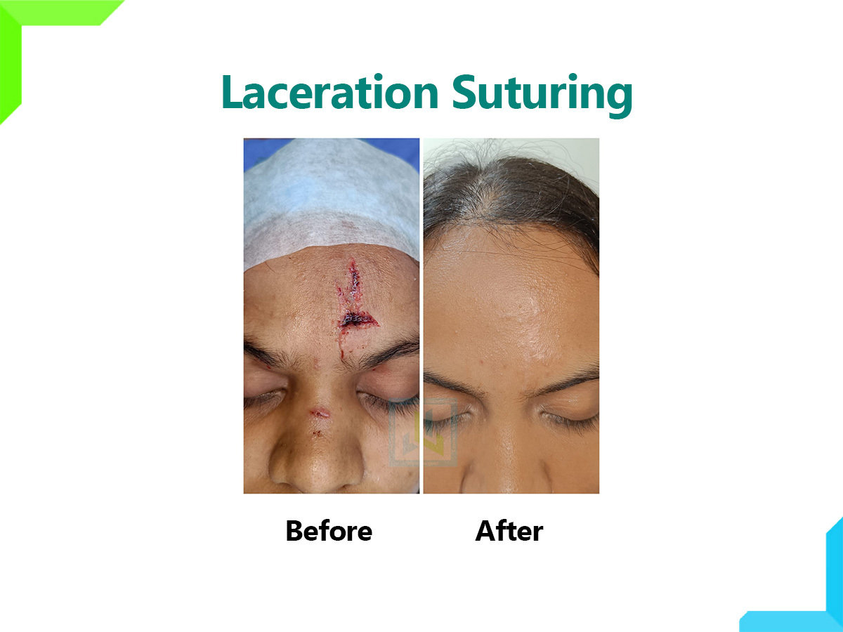 Laceration Suturing | Dr. Leena Jain Laceration Suturing | Dr. Leena Jain