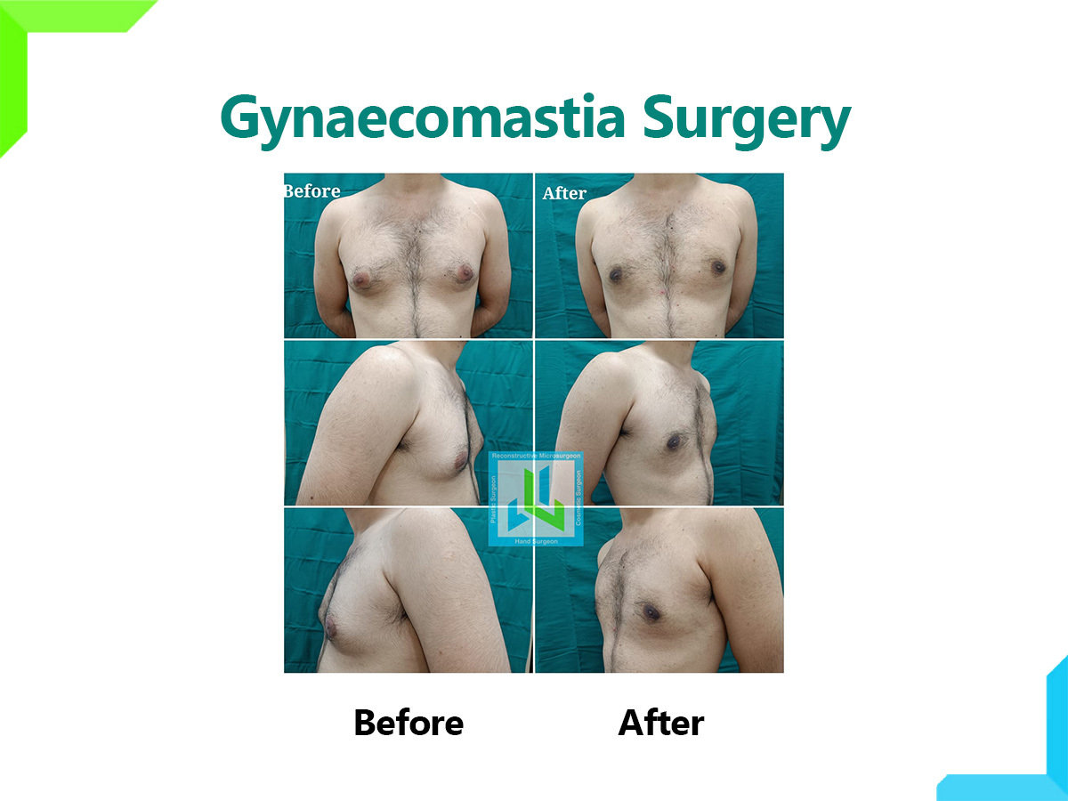 Gynaecomastia Surgery | Dr. Leena Jain Gynaecomastia Surgery | Dr. Leena Jain