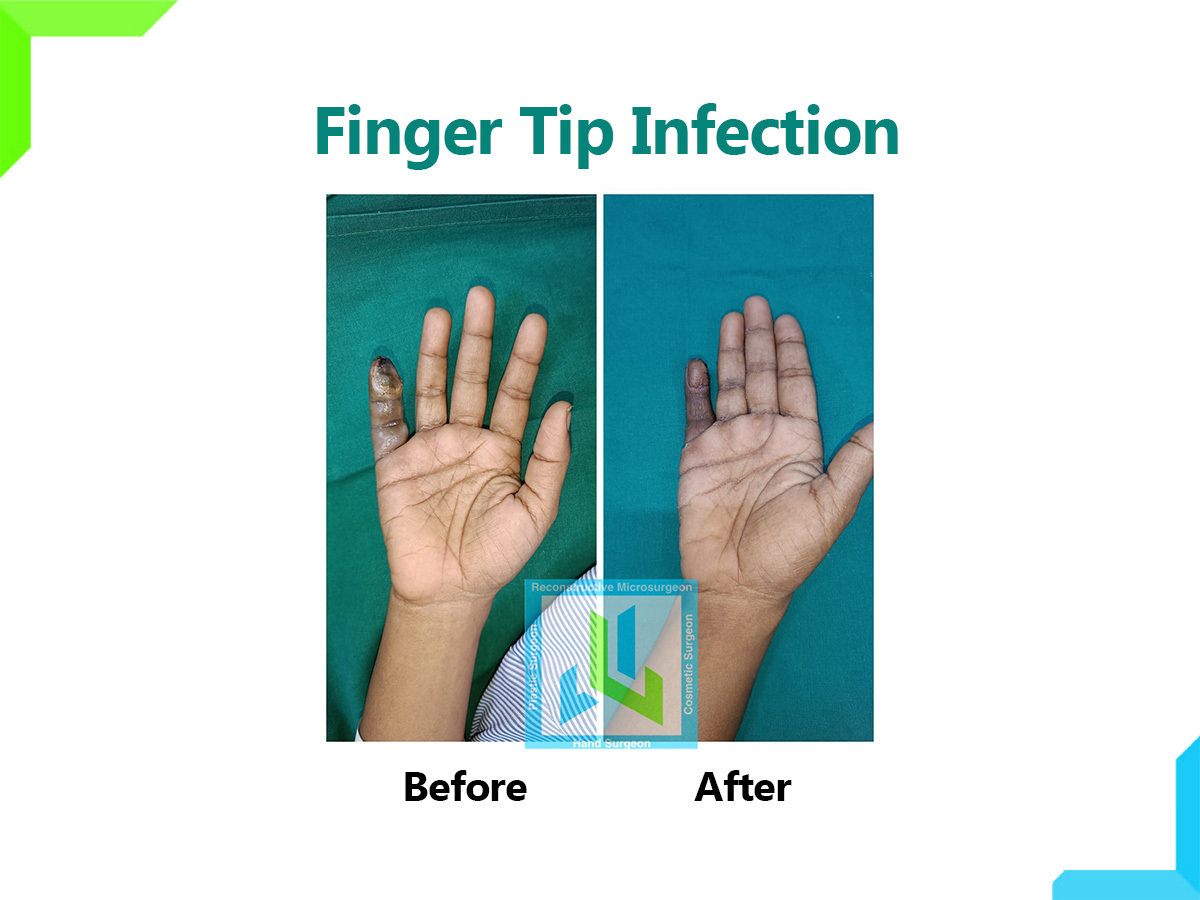 Finger Tip Infection | Dr. Leena Jain Finger Tip Infection | Dr. Leena Jain
