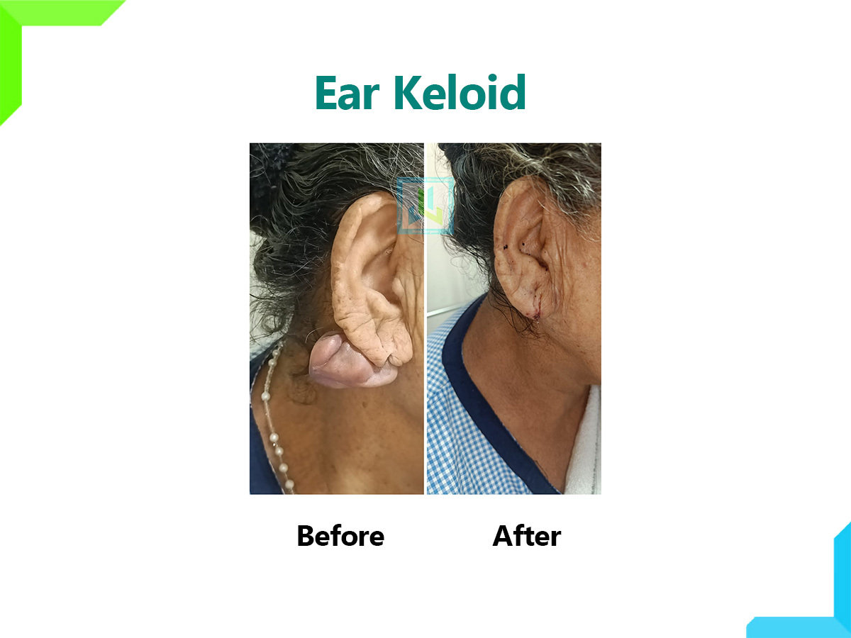 Ear Keloid | Dr. Leena Jain Ear Keloid | Dr. Leena Jain