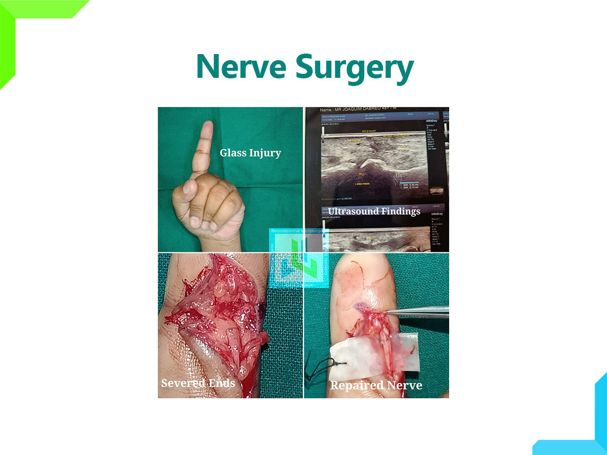 Nerve surgery | Dr. Leena Jain Nerve surgery | Dr. Leena Jain