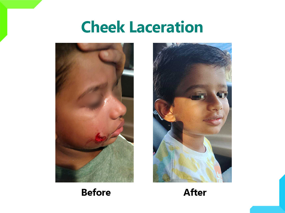 Cheek Laceration | Dr. Leena Jain Cheek Laceration | Dr. Leena Jain