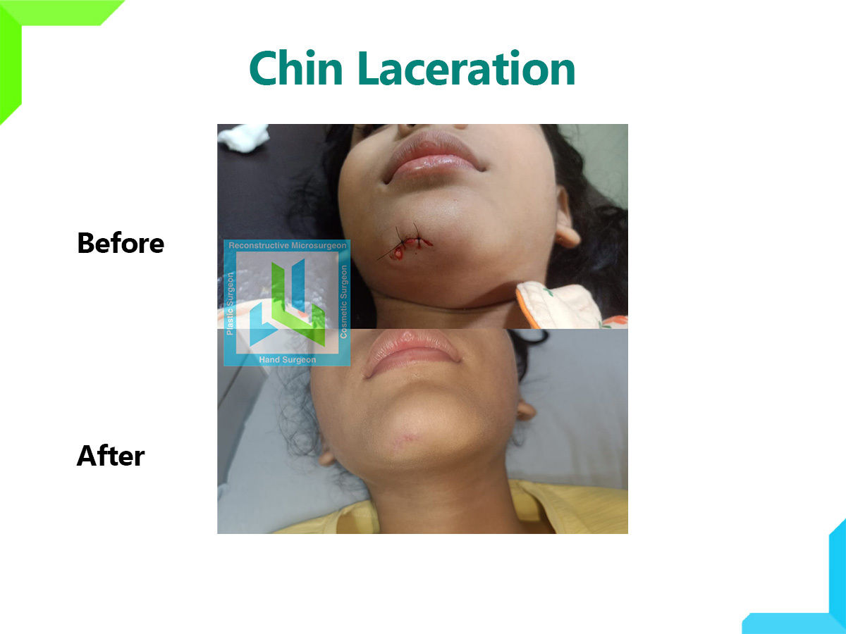 Chin Laceration | Dr. Leena Jain