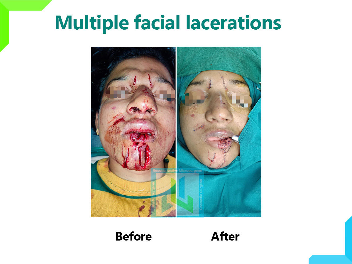Multiple Facial Lecerations | Dr. Leena Jain
