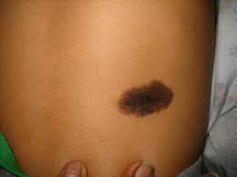Congenital Moles | KDC Clinic
