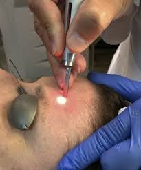 CO2 Laser in faridabad | KDC Clinic