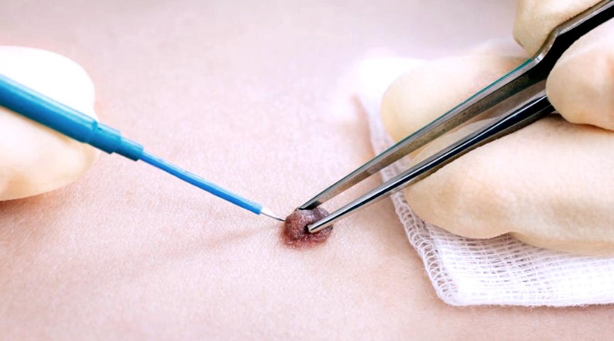 Electrosurgery | Dr. Archit Aggarwal