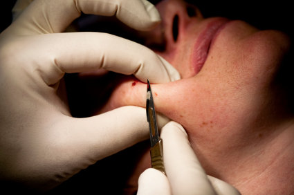 Shave Excision | Dr. Archit Aggarwal