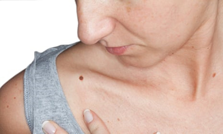 Mole Removal Treatment in Faridabad | KDC Clinic