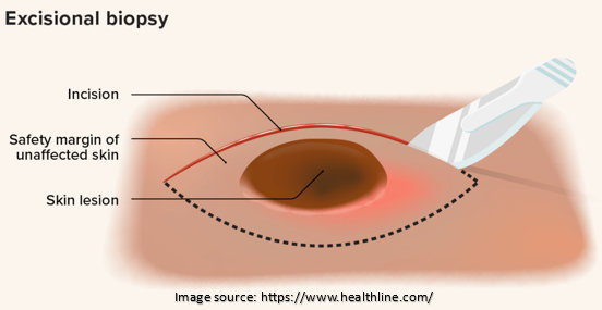 Excisional Biopsy | Dr. Sandeep Nayak