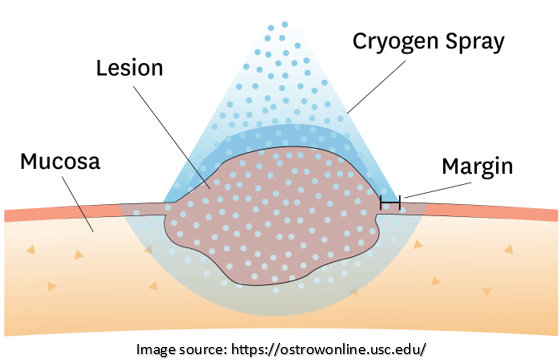 Cryosurgery | Dr. Sandeep Nayak