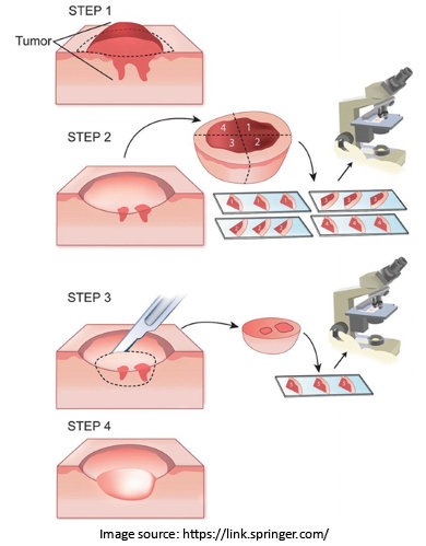 Mohs Surgery | Dr. Sandeep Nayak