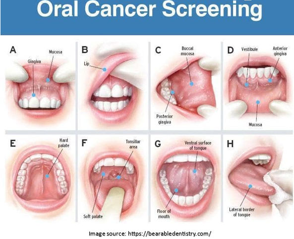 Oral Cancer Screening | Dr. Sandeep Nayak